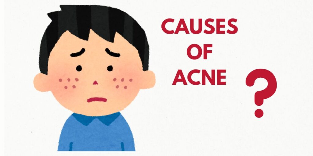 causes of acne