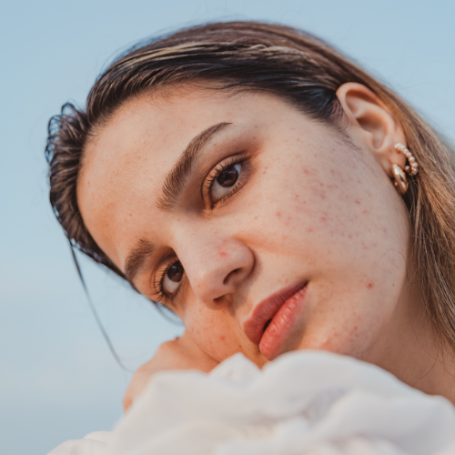 skincare tips for Acne-prone skin type