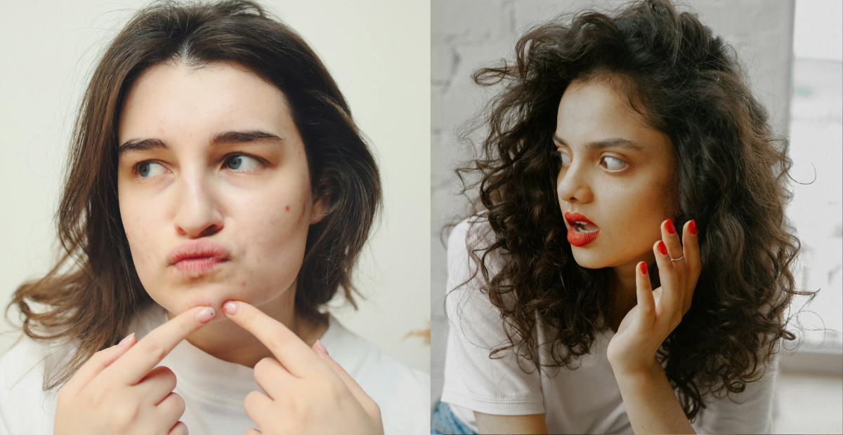 Treat your Acne-prone skin type