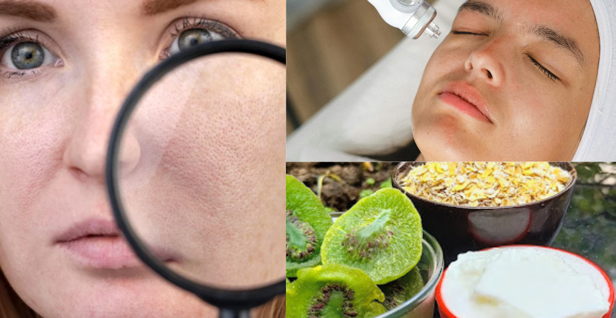 Treat large pores