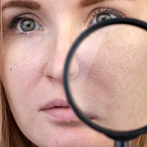Women with pores on her cheek