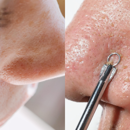 pores on nose