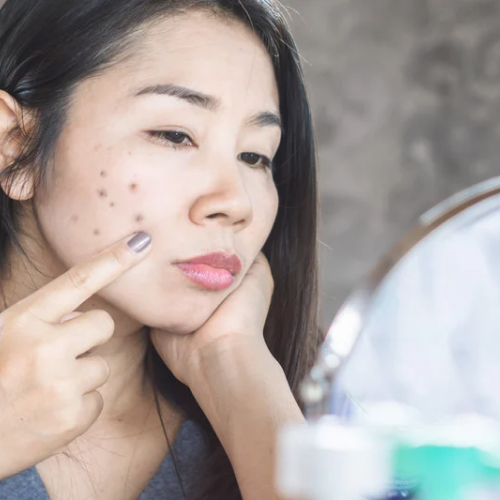 What Causes Acne Marks on Face? A Detailed Guide