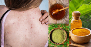 Natural Body Acne Solutions: 10 DIY Soothing recipes you all need