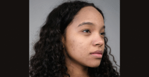 What Causes Acne Marks on Face? A Detailed Guide