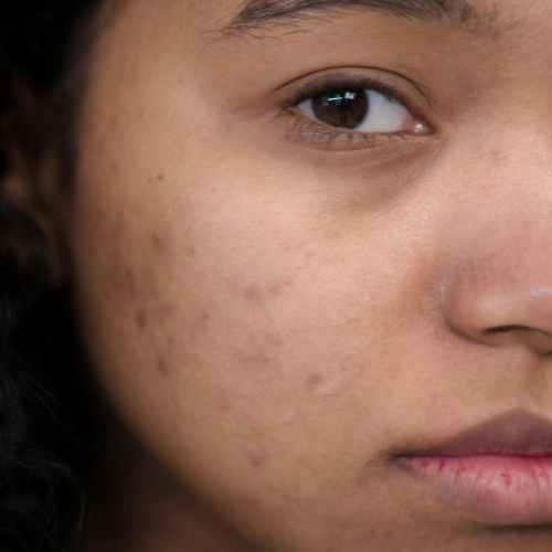 What Cause Acne Marks on Face?