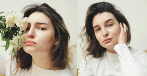 Acne Alert: Common causes and effective solutions to prevent Acne